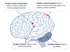 Lugar de lesión y parálisis cerebral